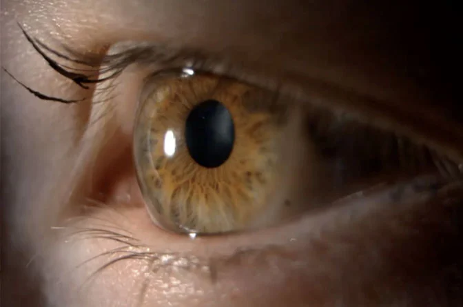 Understanding Keratoconus Lenses: A Visionary Solution Using Scleral Lenses